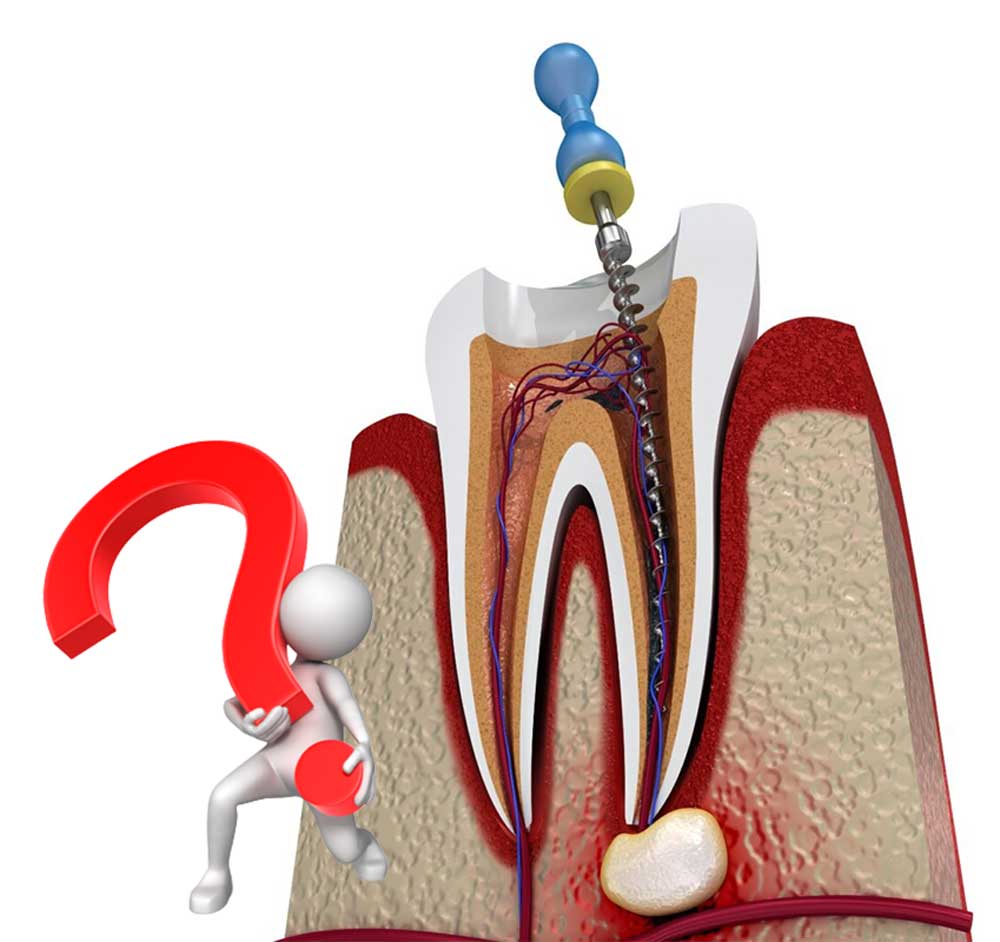 سوالات متداول عصب کشی یافت آباد