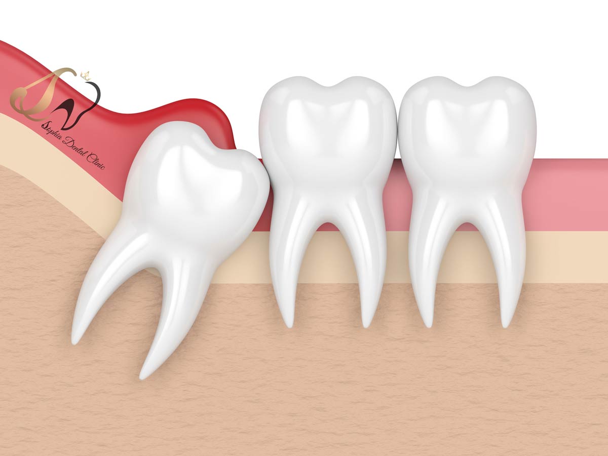 جراحی دندان عقل در یافت آباد