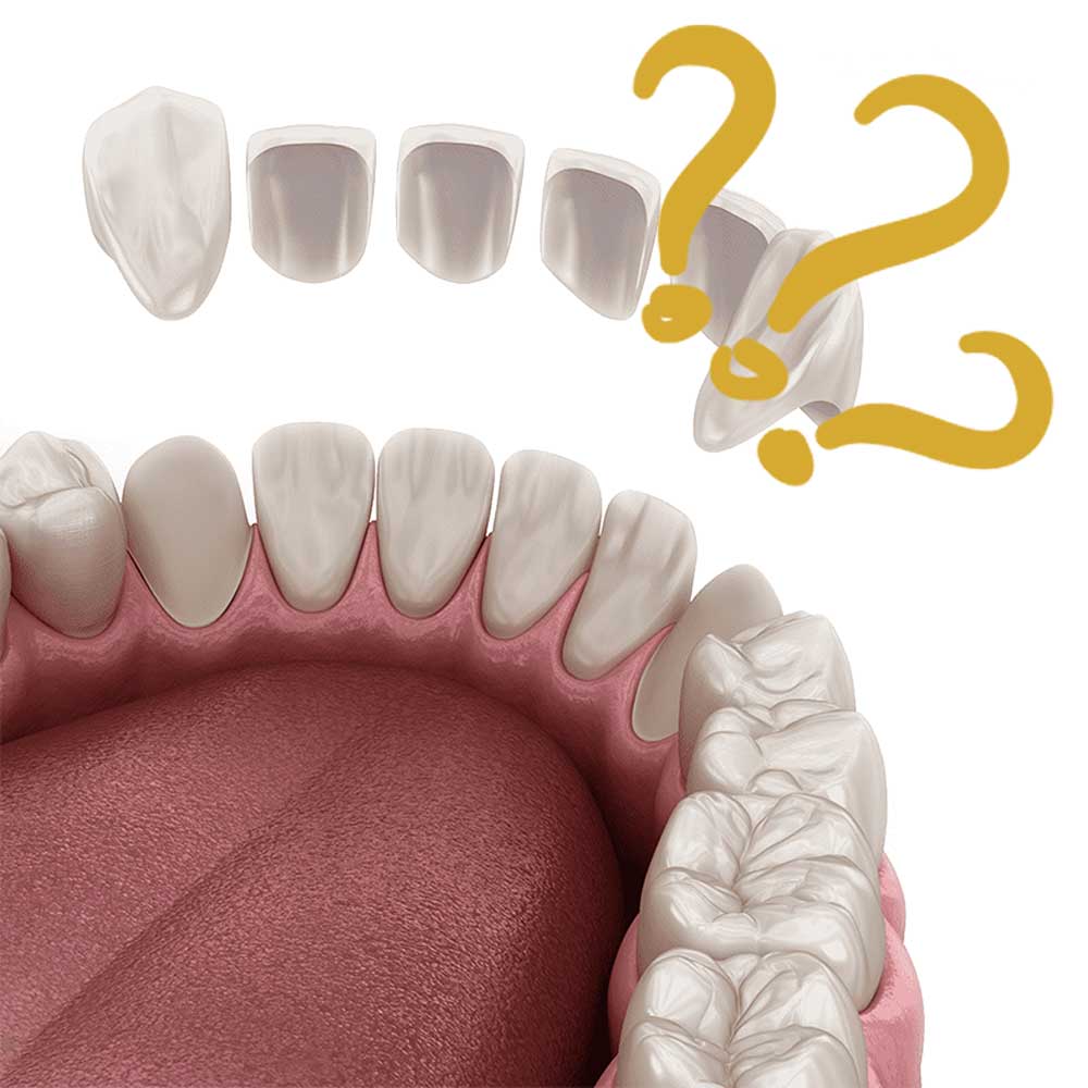 سوالات لمینت دندان یافت آباد