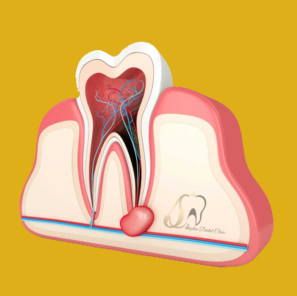 زمان عصب کشی در یافت آباد