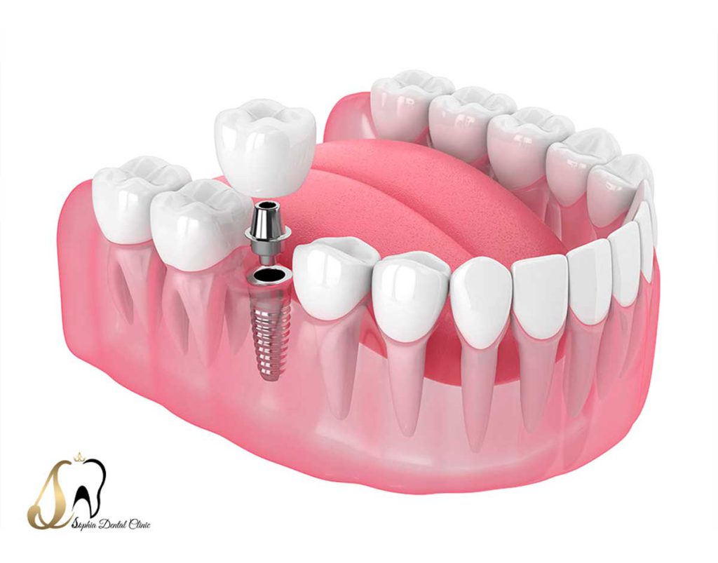 ایمپلنت دندان یافت آباد