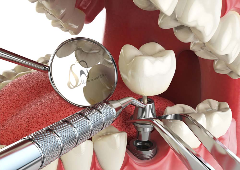 ایمپلنت یافت آباد