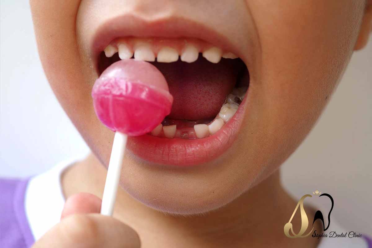 درمان پوسیدگی دندان شیری کودک