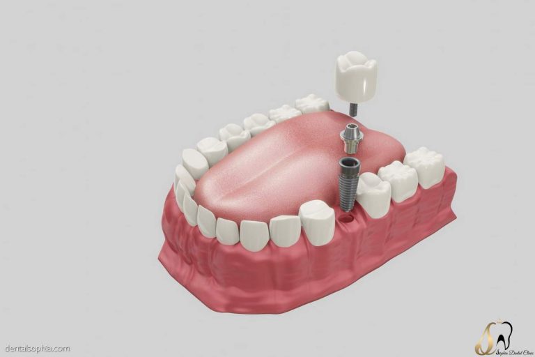 در موارد زیر ایمپلنت مناسب نیست