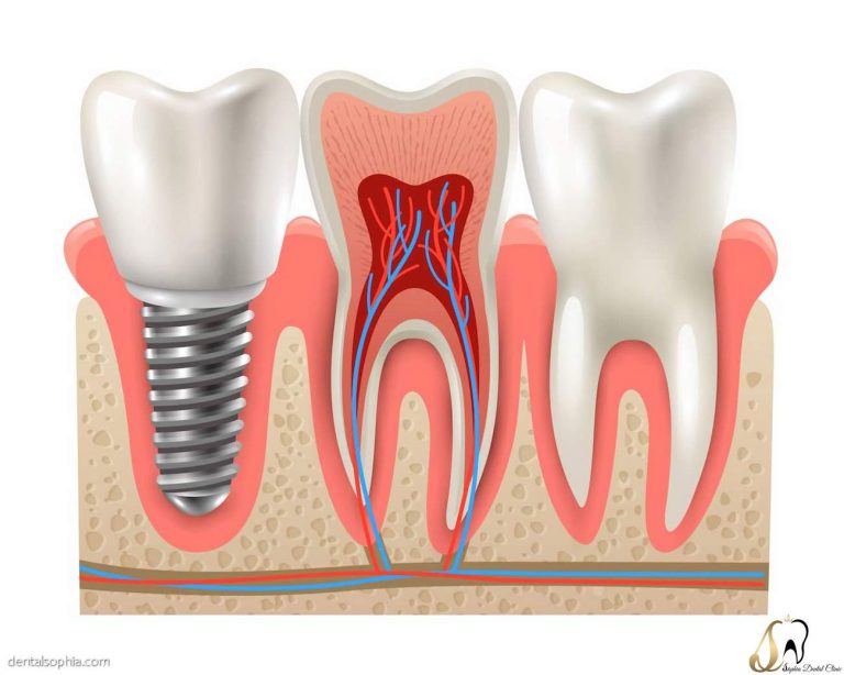 مراحل کاشت ایمپلنت دندان