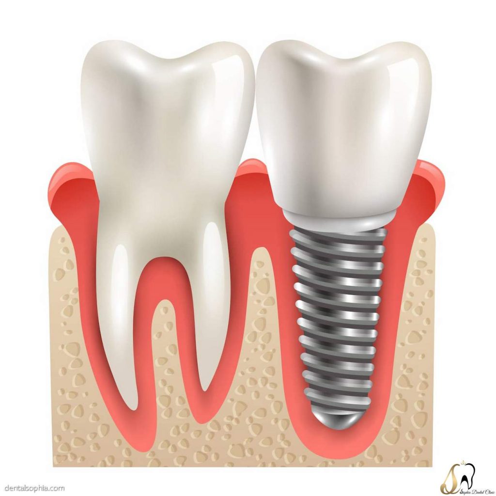 ایمپلنت دندان چیست