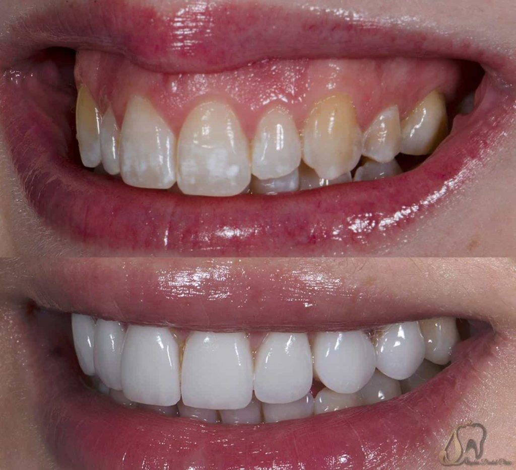 لبخندی زیبا با لیفت لثه: خداحافظی به لبخند لثه‌ای!