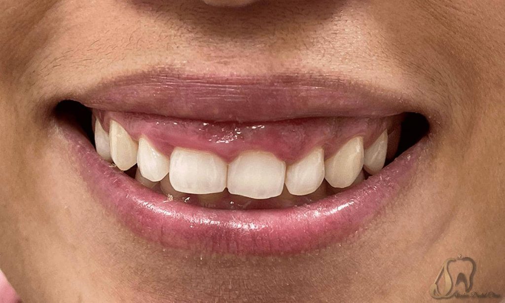 مزایای لیفت لثه با لیزر