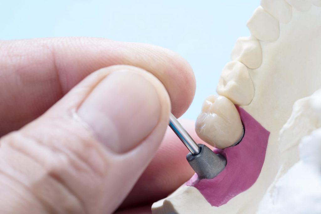 ایمپلنت‌های دندانی نامناسب دندانپزشکی سوفیا