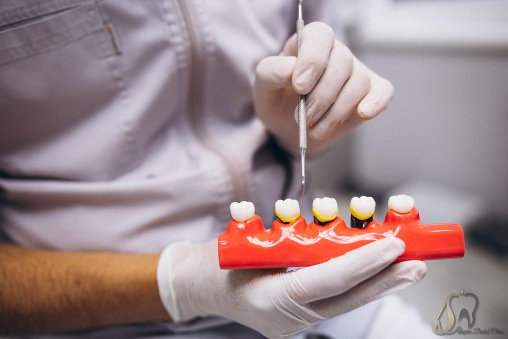 انواع ایمپلنت دندان