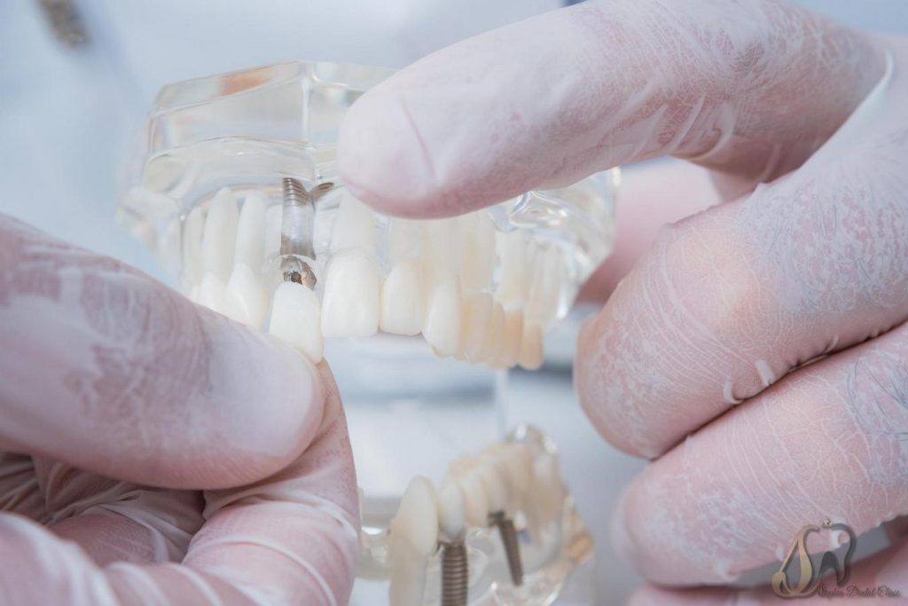 انواع پروتز دندان ثابت