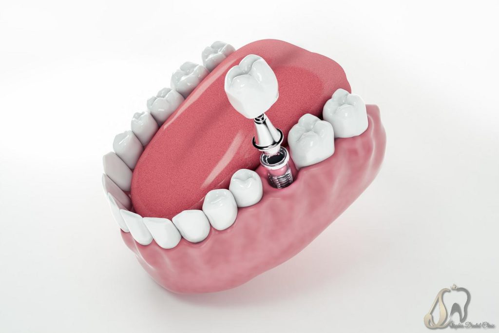 ایمپلنت دندان چیست