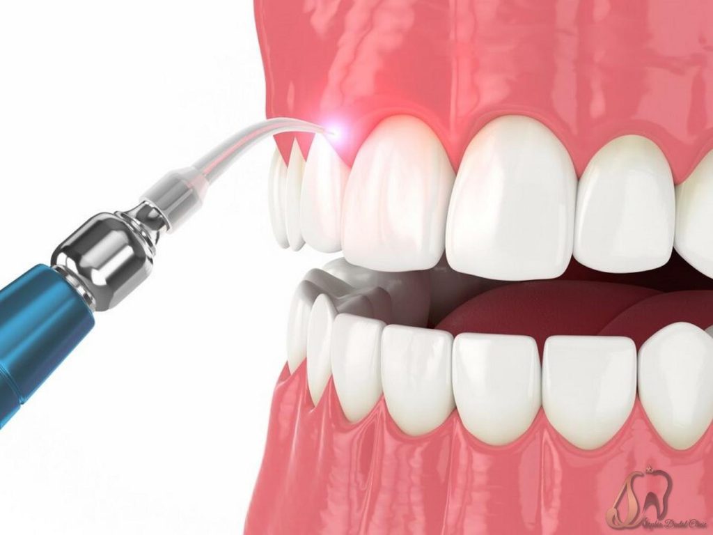 چه کسانی کاندیدای مناسبی برای لیفت لثه با لیزر هستند