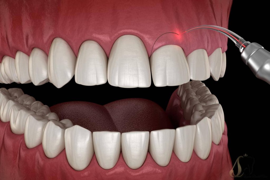 تصویر شاخص لیفت لثه با لیزر