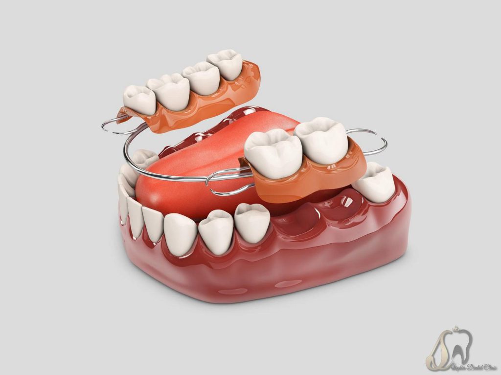 تصویر شاخص پروتز‌های دندانی چیست؟ هر آنچه که درباره پروتز دندان باید بدانید!