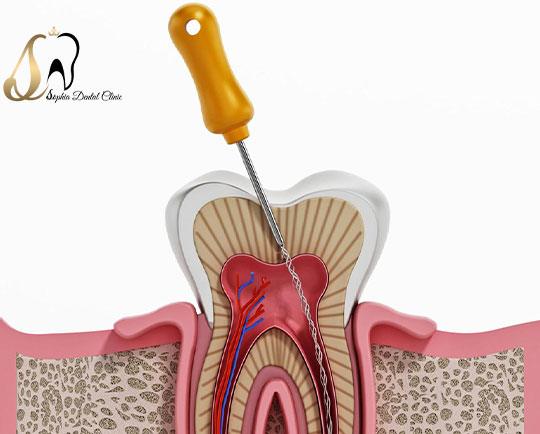 مزایا و معایب عصب کشی دندان