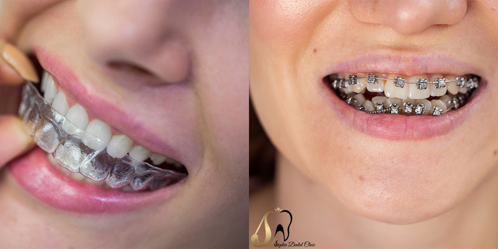 مقایسه ارتودنسی نامرئی در مقابل بریس مزایا و معایب هر کدام
