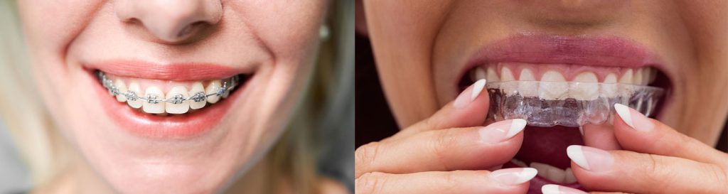 ارتودنسی نامرئی در مقابل بریس