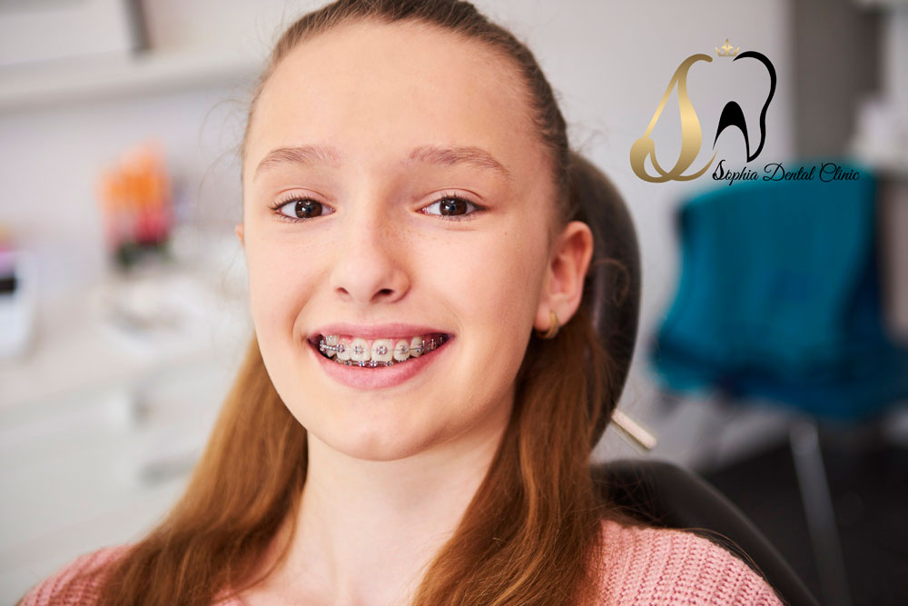 بریس‌های ارتودنسی چیست؟