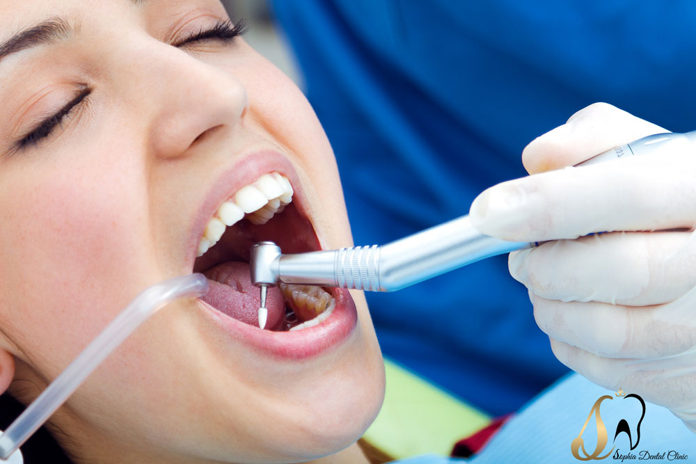 عصب کشی چیست؟