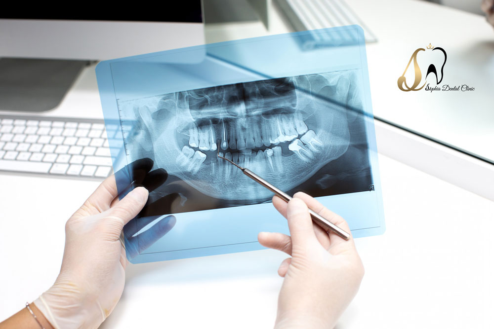 درمان عفونت لثه به چه صورت است؟