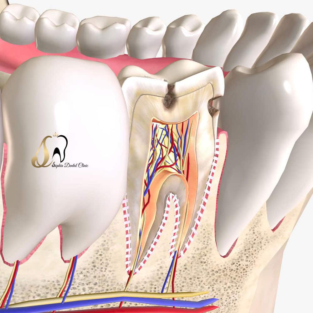 عصب کشی دندان چگونه انجام میشود؟