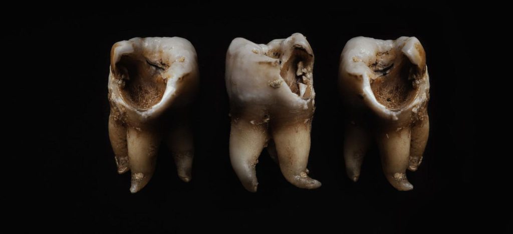 آیا عصب کشی دندان ها خیلی دردناک هستند؟