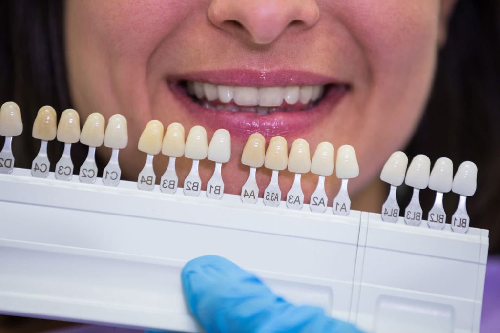 نحوه بلیچینگ دندان