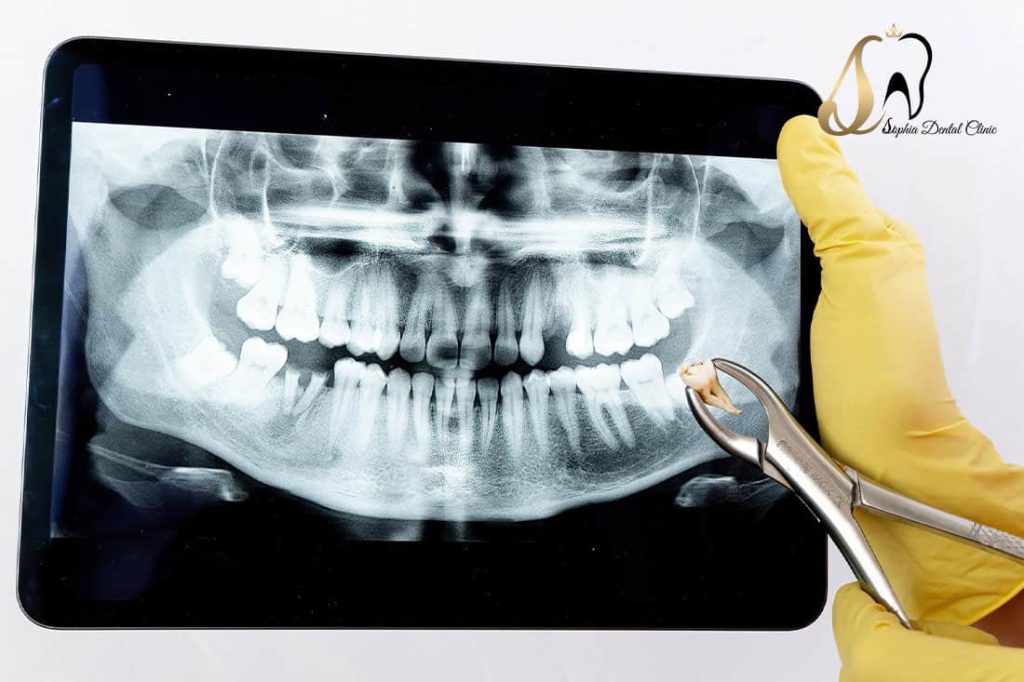 رادیو گرافی دندان به چه صورت انجام میشود؟