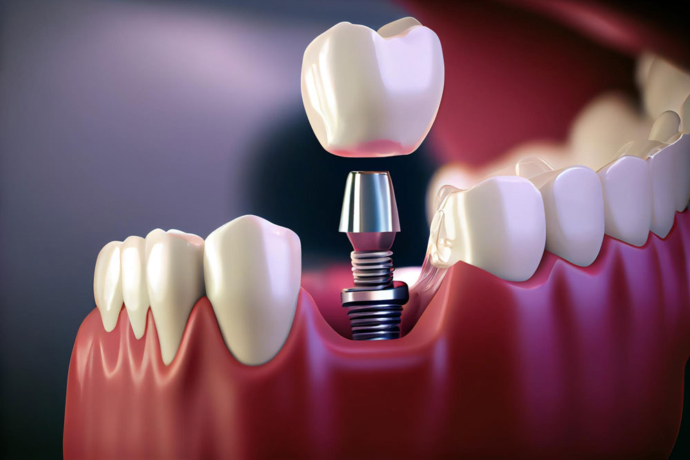 ایمپلنت دندان چیست؟