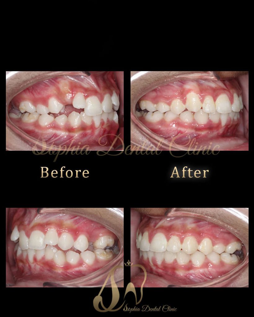 نمونه کار ارتودنسی در کلینیک دندانپزشکی سوفیا 2