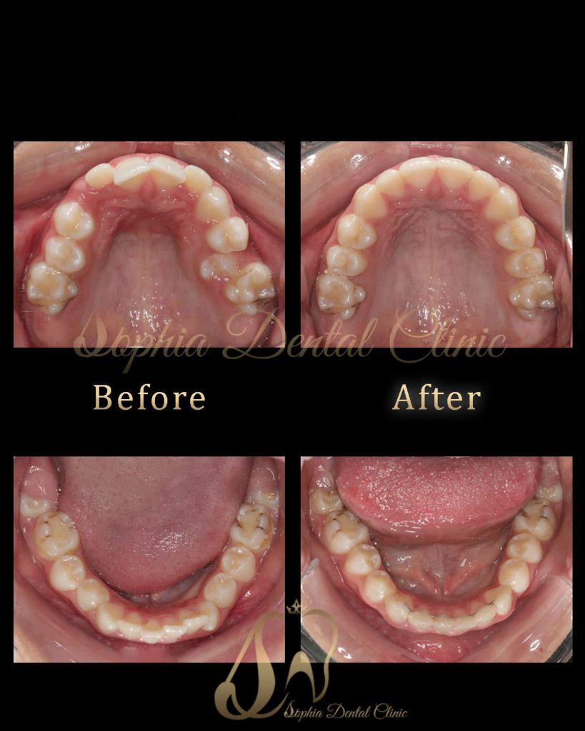 نمونه کار ارتودنسی در کلینیک دندانپزشکی سوفیا 3