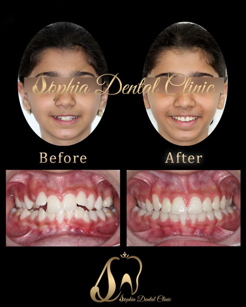 نمونه کار ارتودنسی در کلینیک دندانپزشکی سوفیا1