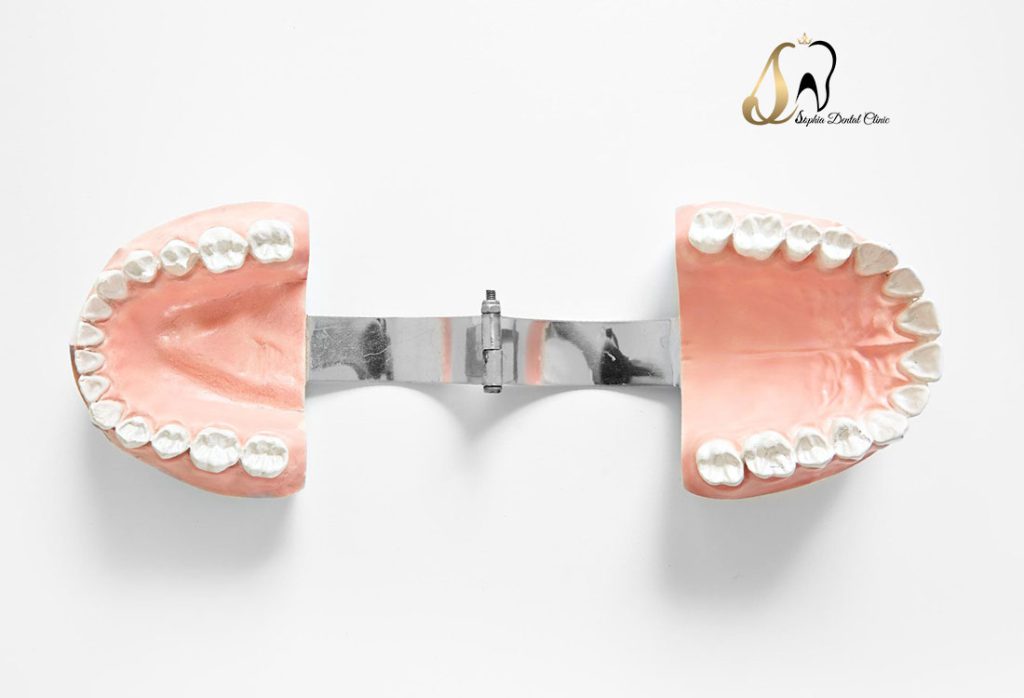 مزایا و معایب پروتزهای دندانی