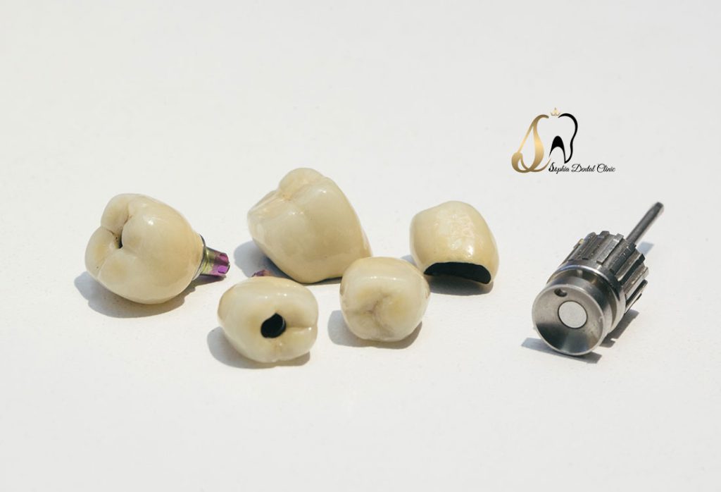 انواع مختلف پروتز های دندانی