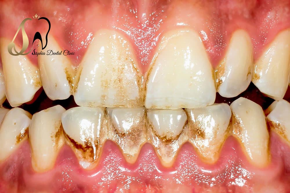 جرمگیری دندان برای چه کسانی ضروری است؟