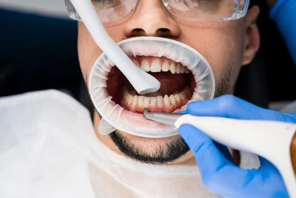 اسلایدر پست جرمگیری دندان به چه صورت انجام می شود؟