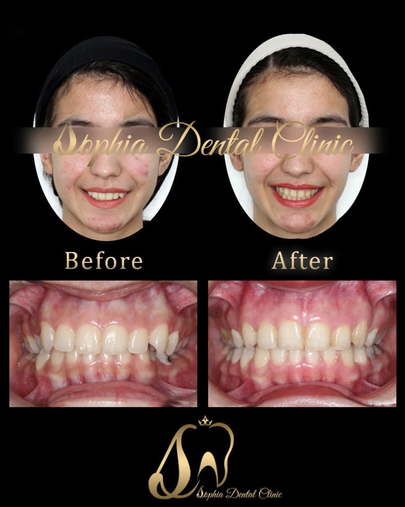 نمونه کار های ترمیمی و‌ زیبایی دندان در کلینیک سوفیا