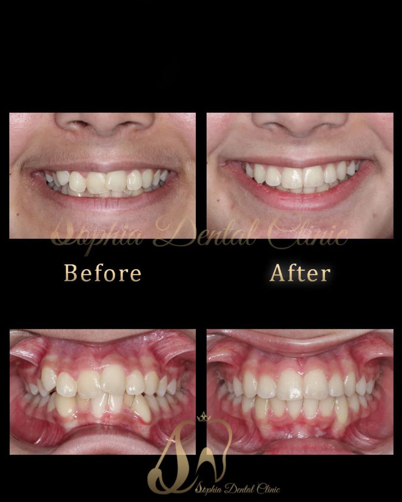 نمونه کار های ترمیمی و‌ زیبایی دندان در کلینیک سوفیا