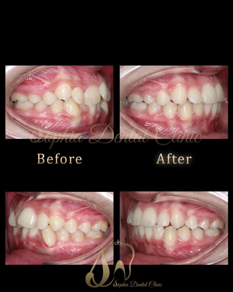 نمونه کار های ترمیمی و‌ زیبایی دندان در کلینیک سوفیا