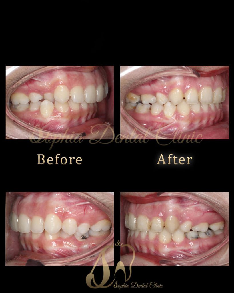 نمونه کار های ترمیمی و‌ زیبایی دندان در کلینیک سوفیا