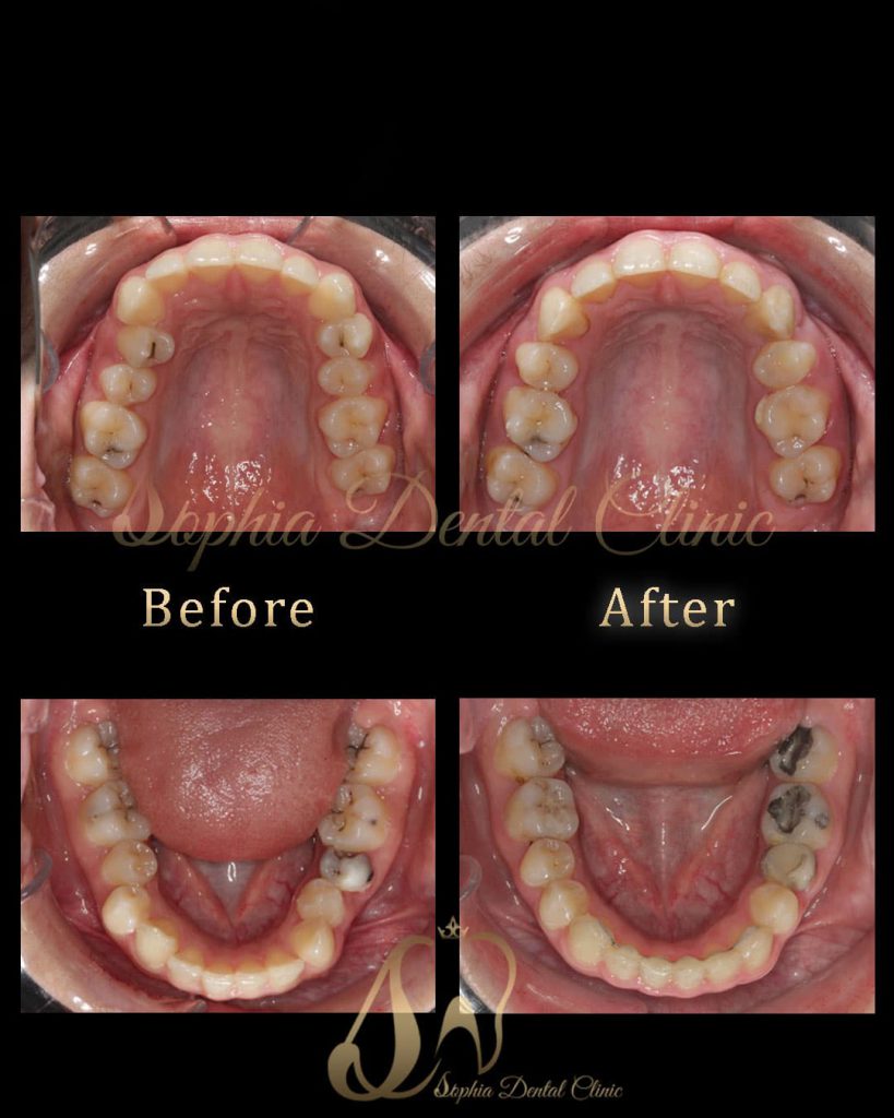 نمونه کار های ترمیمی و‌ زیبایی دندان در کلینیک سوفیا