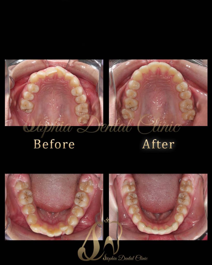 نمونه کار های ترمیمی و‌ زیبایی دندان در کلینیک سوفیا