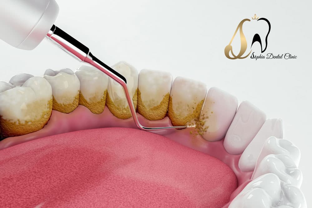 جرم‌گیری دندان چیست؟