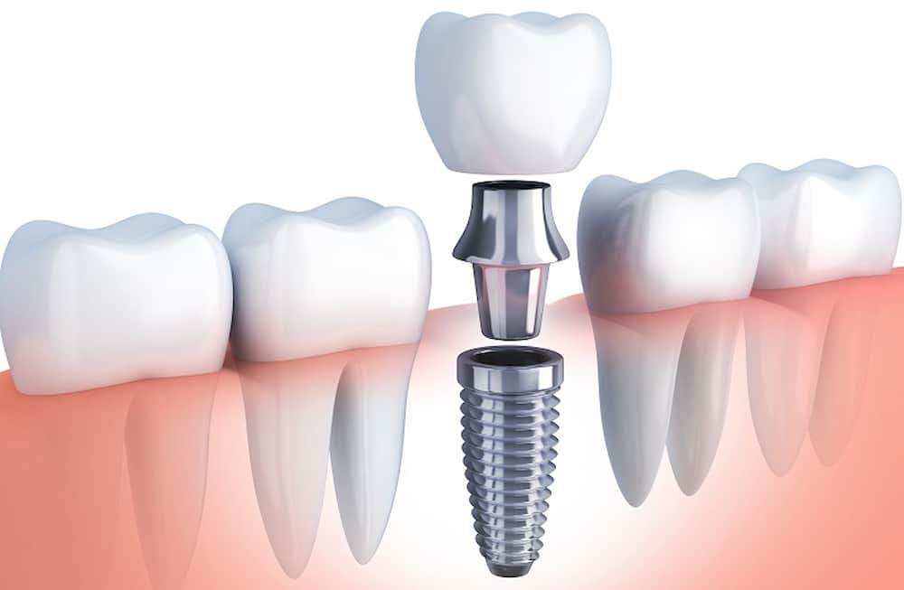 همه چیز در مودر ایمپلنت دندان