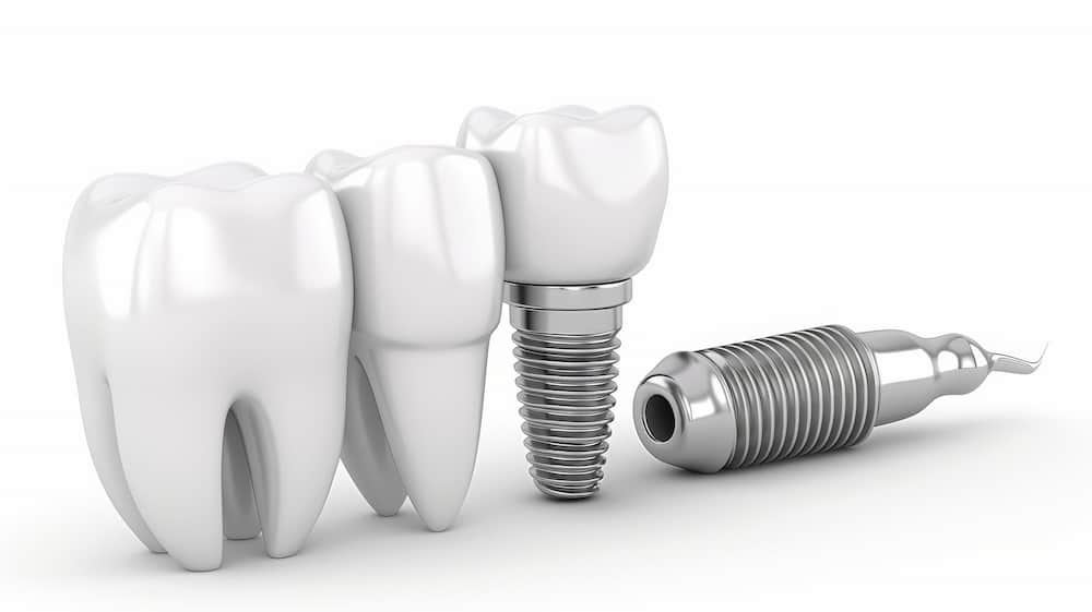 همه چیز در مودر ایمپلنت دندان