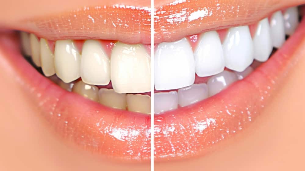 مزایا و معایب بلیچینگ دندان