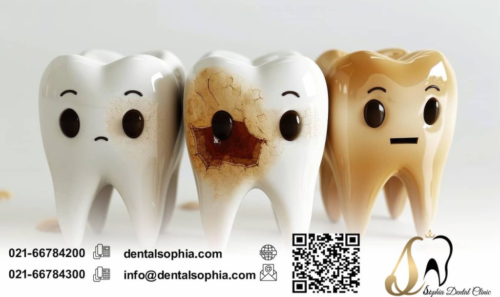 پیشگیری از پوسیدگی دندان و خرابی دندان