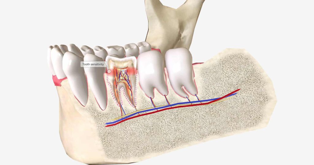 عکس شاخص مراقبت از دندان عصب کشی شده