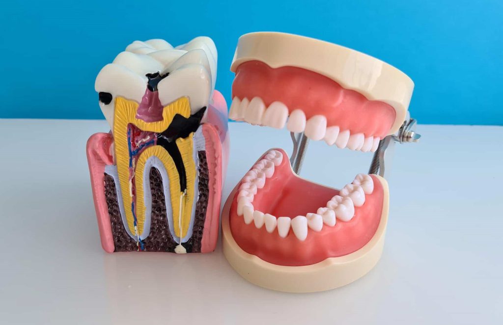 مقایسه عصب‌کشی و کشیدن دندان